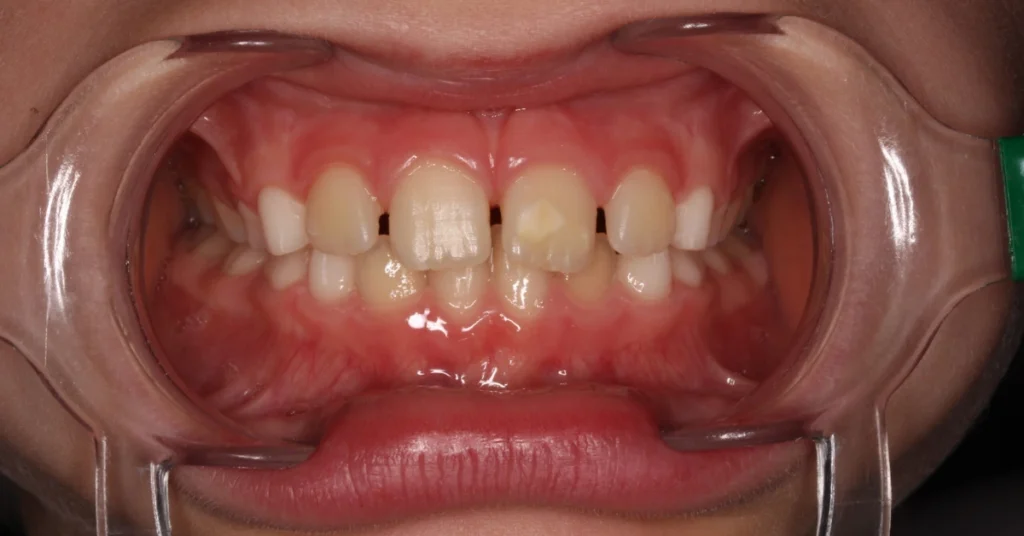 manchas nos incisivos e molares